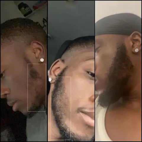 Kirkland Minoxidil 5% (with derma roller 0.5mm and lclt for hair and beard growth Bwetinde B Enterprises