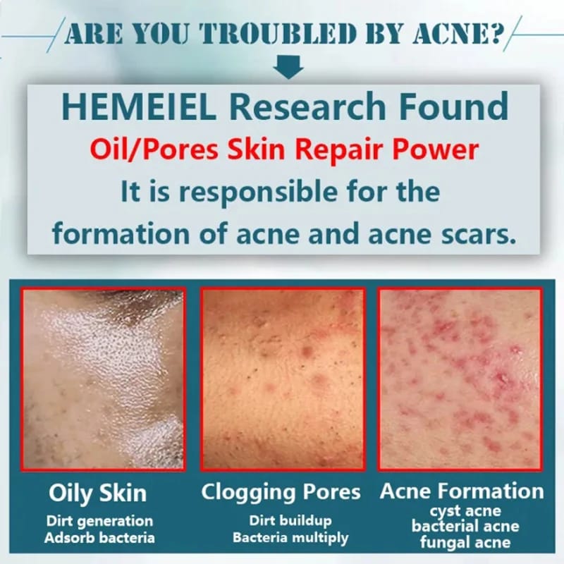 Sadoer Tea Tree Anti-Acne Serum 30ml - Oil Control Face Treatment Bwetinde B Enterprises