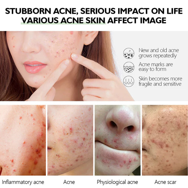 VIBRANT GLAMOUR Herbal Acne Treatment Serum 17ml Bwetinde B Enterprises