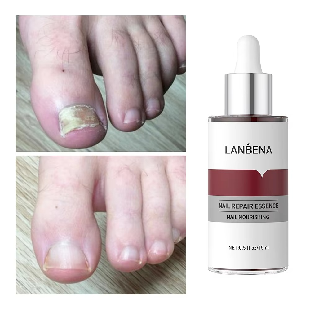 LANBENA Nail Repair Serum Feet Care Strength Liquid for Damaged Nails