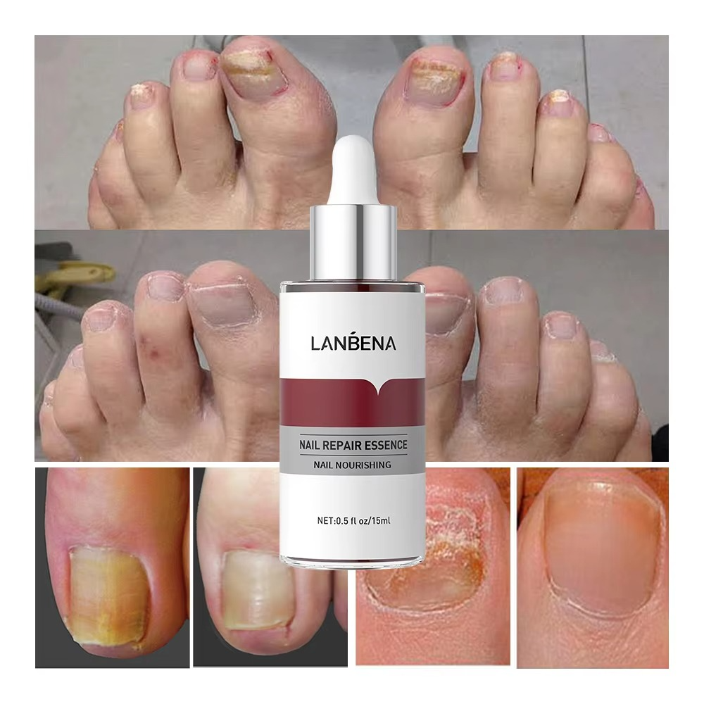 LANBENA Nail Repair Serum Feet Care Strength Liquid for Damaged Nails