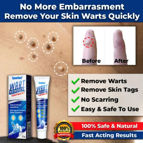 Wart Remover Ointment 20g - Topical Cream for Warts, Skin Tags & Corns Bwetinde B Enterprises