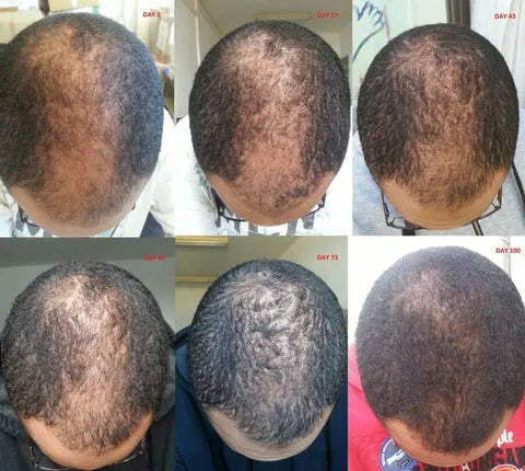 Kirkland Minoxidil 5% Hair Growth Kit with Derma Roller - Uganda