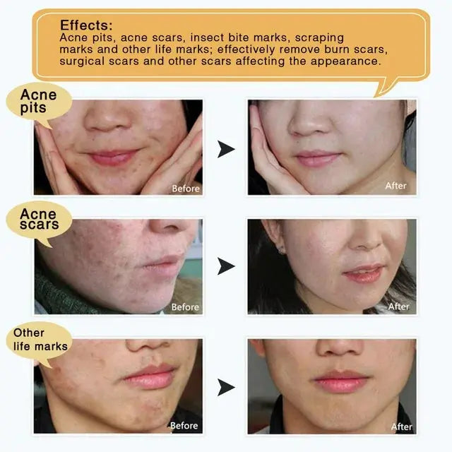 TCM Scar Removing Gel