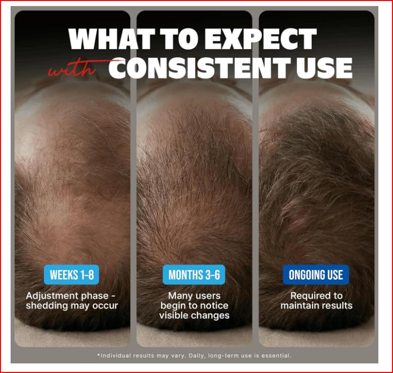 Minoxidil Topical Solution USP 5%, Extra Strength Hair Regrowth Treatment for Men, 6 Months Supply