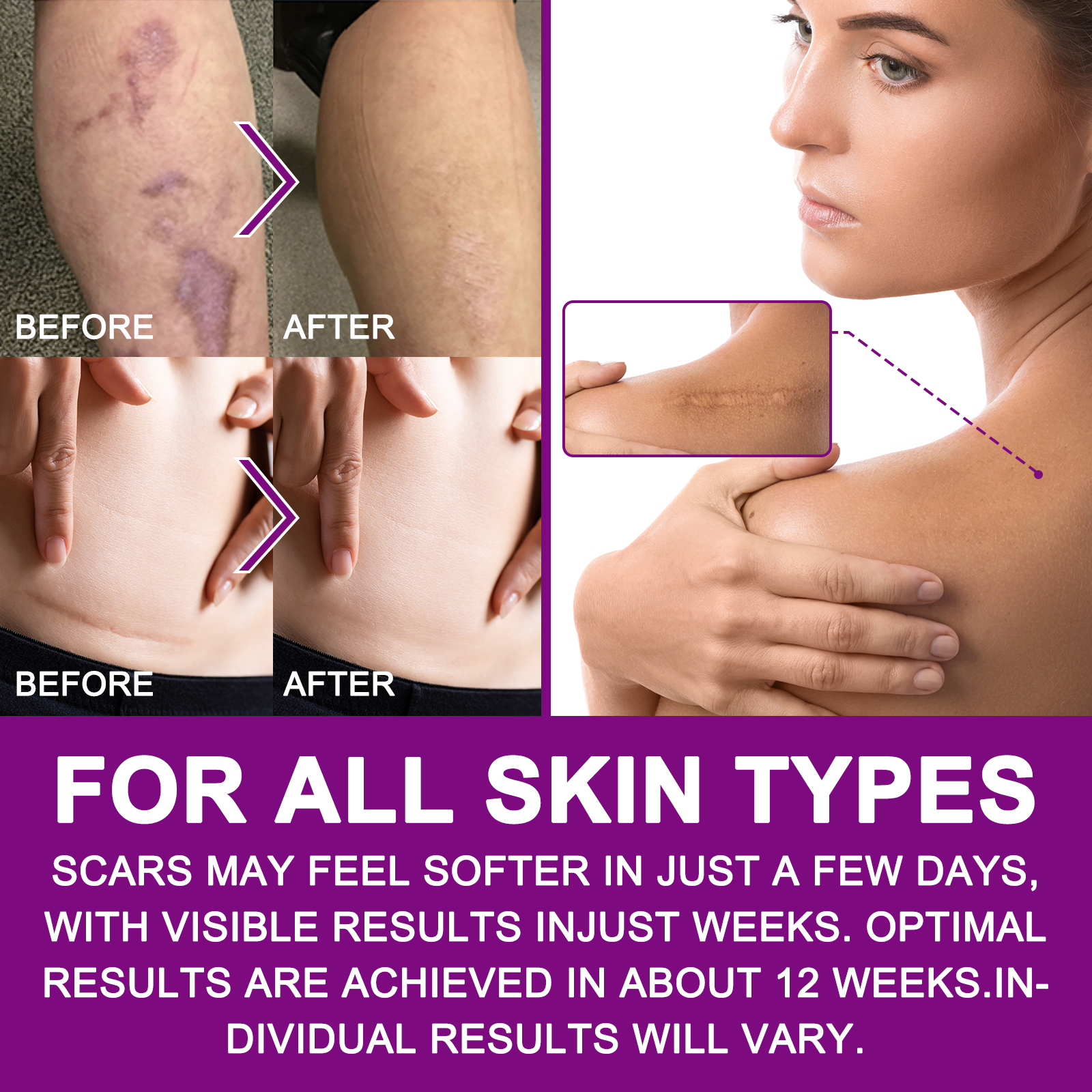  Elaimei Scar Removal Treatment Transparent Waterproof Silicone Scar Sheet