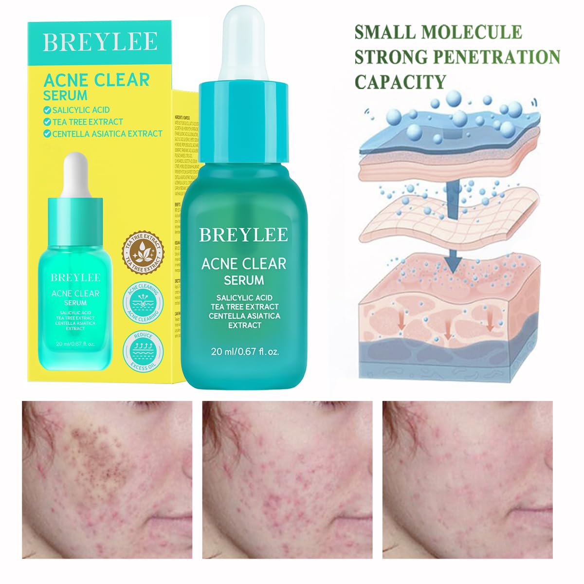 Tea Tree Acne Treatment Serum, Salicylic Acid & Centella Asiatica Serum for Severe Acne, Breakouts, Pimple Remover,Skin Repair (20ml,0.67oz)