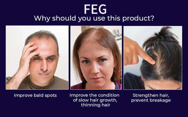 FEG Hair & Beard Growth Serum Kit with Derma Roller